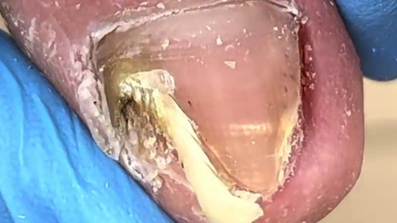 Proceso de tratamiento de la onicomicosis Reparación completa