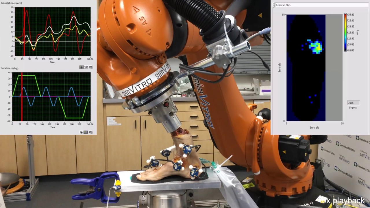 Foot/Ankle Testing with simVITRO Network Drivers for Tekscan