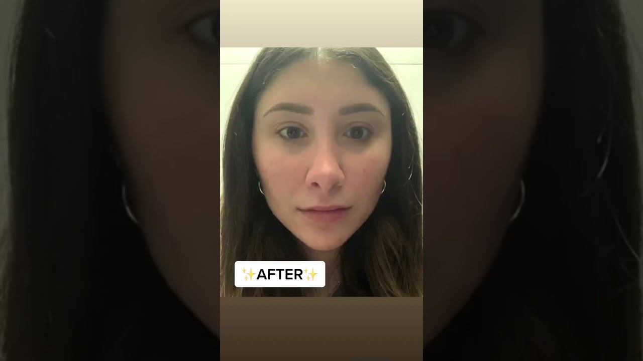 Buccal fat removal BEFORE & AFTER #plasticsurgery #beforeandafter