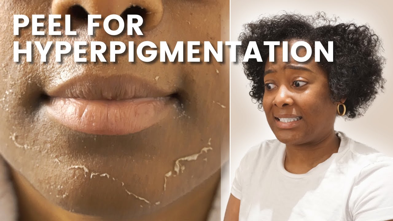 CHEMICAL PEEL ON BLACK SKIN  | Tranexamic Acid #Vlog
