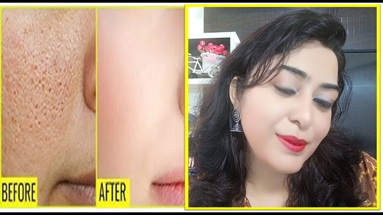 Get Rid of LARGE PORES in 3 Days  | Open Pores Treatment at home | खुले रोम छिद्रों को कैसे बंद करें