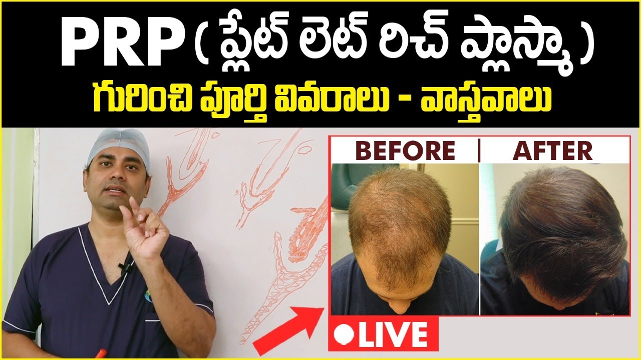 రాలిన జుట్టుకి PRP ట్రీట్మెంట్ || PRP Hair Loss Treatment In Telugu || Celestee Skin And Hair Clinic