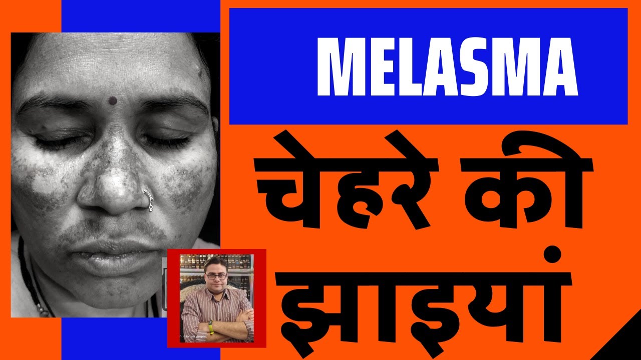 melasma || chloasma || chloasma homeopathic treatment  !