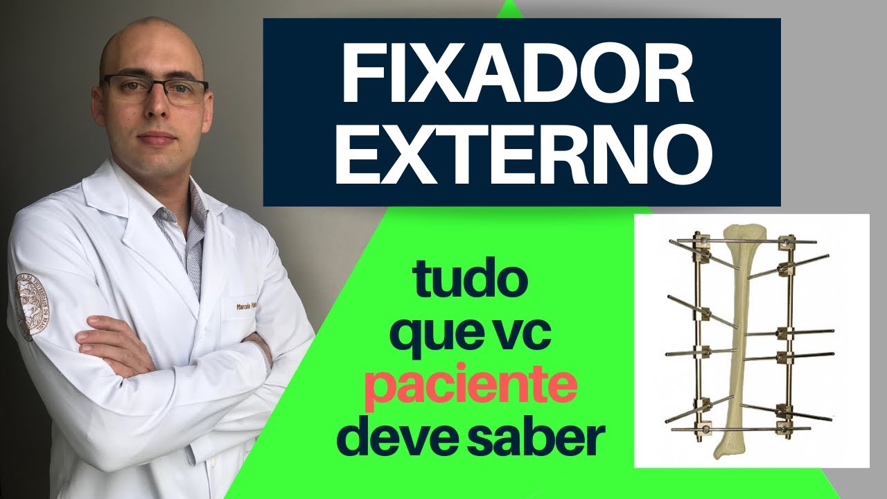 FIXADOR EXTERNO - Pra que serve? CUIDADOS! Os tipos? Quando são colocados? Como são retirados?