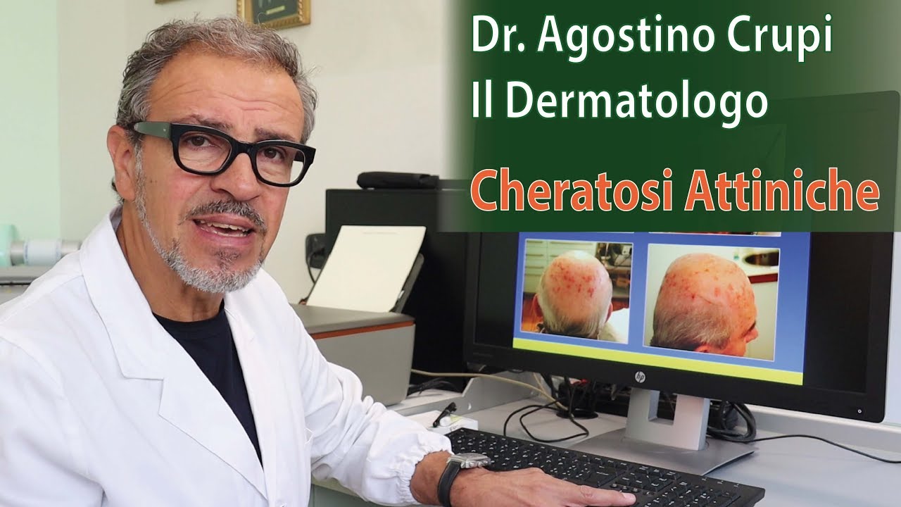 Agostino Crupi - Le Cheratosi Attiniche: come curarle