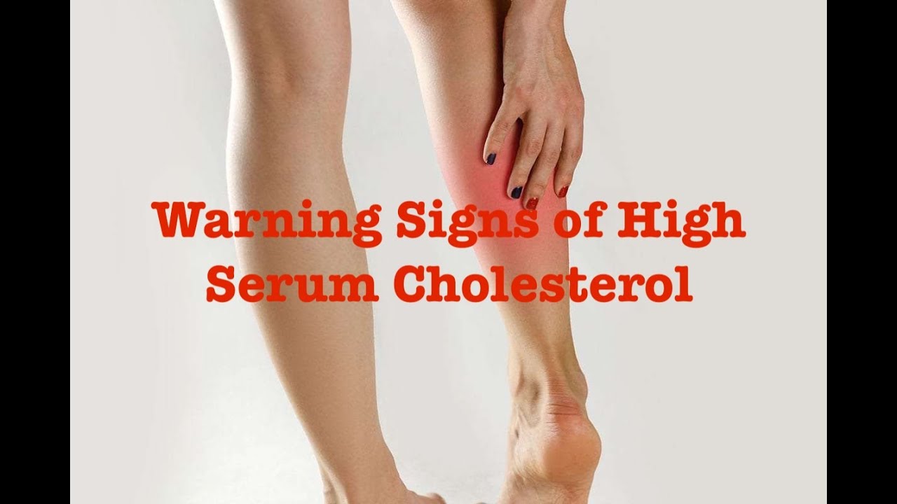 Warning Signs of High Serum Cholesterol (Manipuri) ꯀꯣꯂꯦꯁ꯭ꯇꯦꯔꯣꯜ ꯋꯥꯡꯕꯒꯤ ꯈꯨꯗꯝ