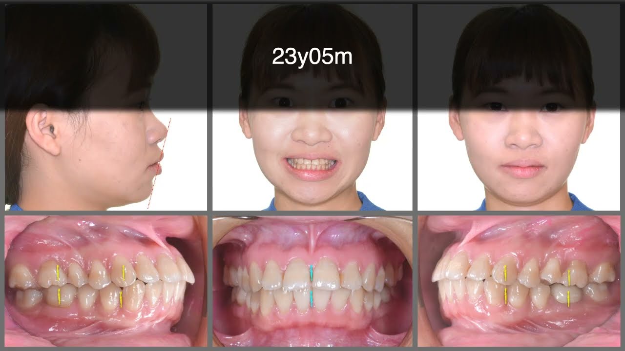 Molar tilting after space closure｜【Chris Chang Ortho】CC597