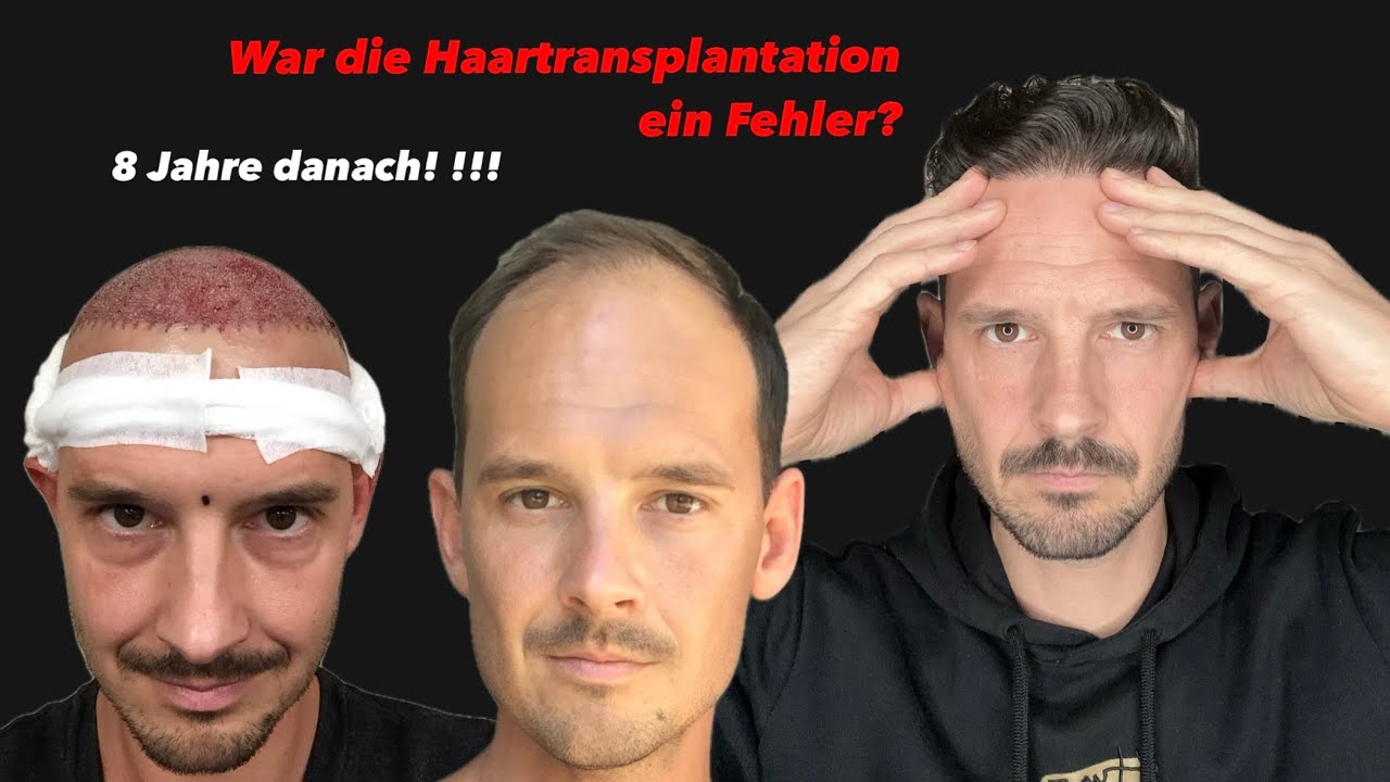 Haartransplantation: Erfolg oder Fehler?  8 Jahre später