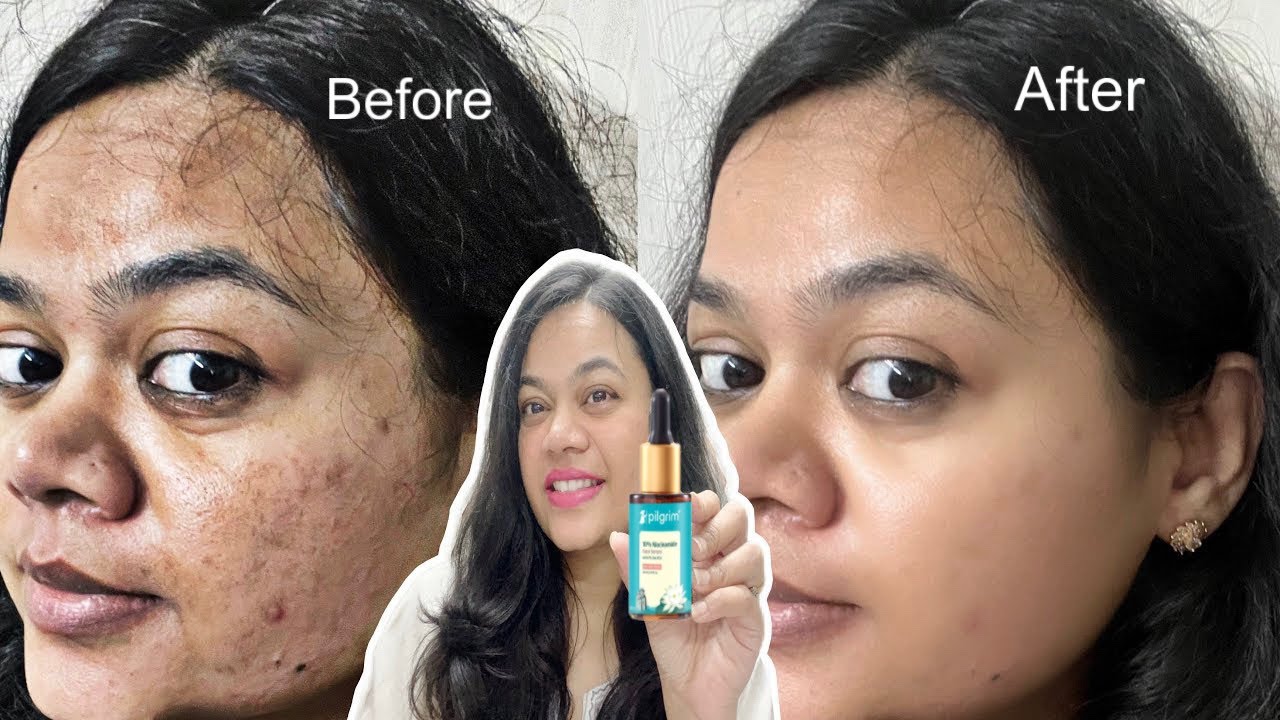 “Pilgrim 10% Niacinamide Serum Review & How to Use? | 30 Din Use Karke Result Dekha 😦”