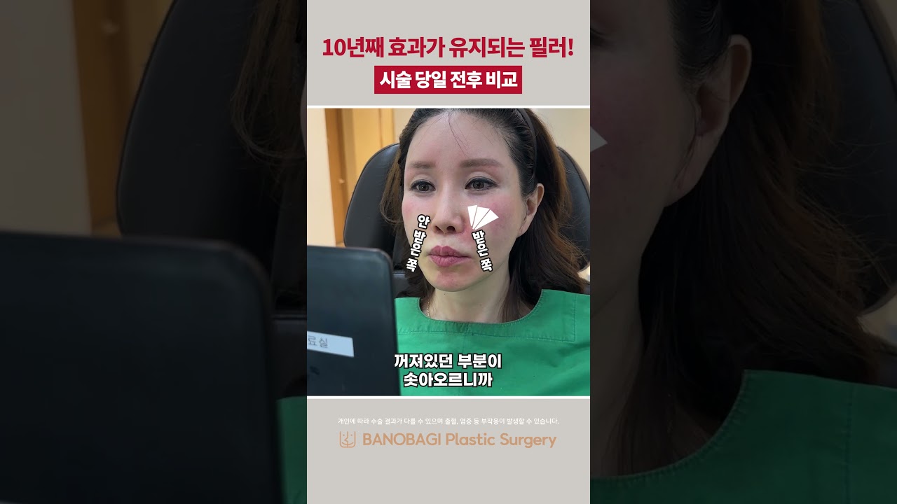 한번 맞고 10년 동안 효과 보는 동안 필러 추천💖 팔자 주름 개선 시술 당일 전후 비교🔥