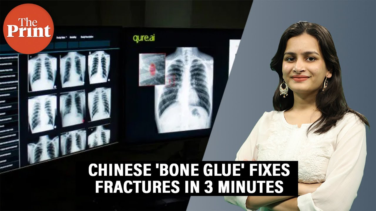 'Bone Glue' created by Chinese scientists claims to fix fractures in 3 minutes: How it works