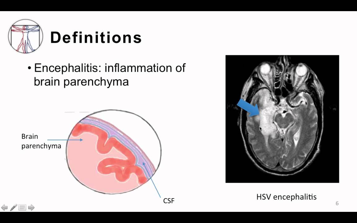 2. Bacterial Meningitis Pathogenesis and Clinical Manifestion