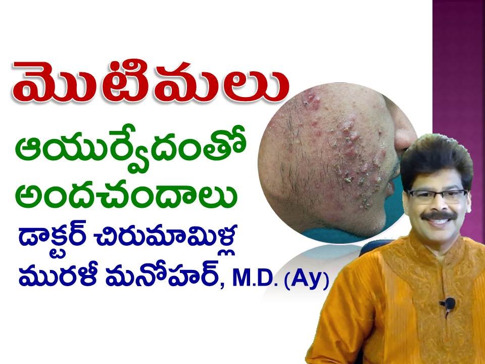 Acne | Sure Cure | Telugu | Dr. Murali Manohar Chirumamilla, M.D. (Ayurveda)