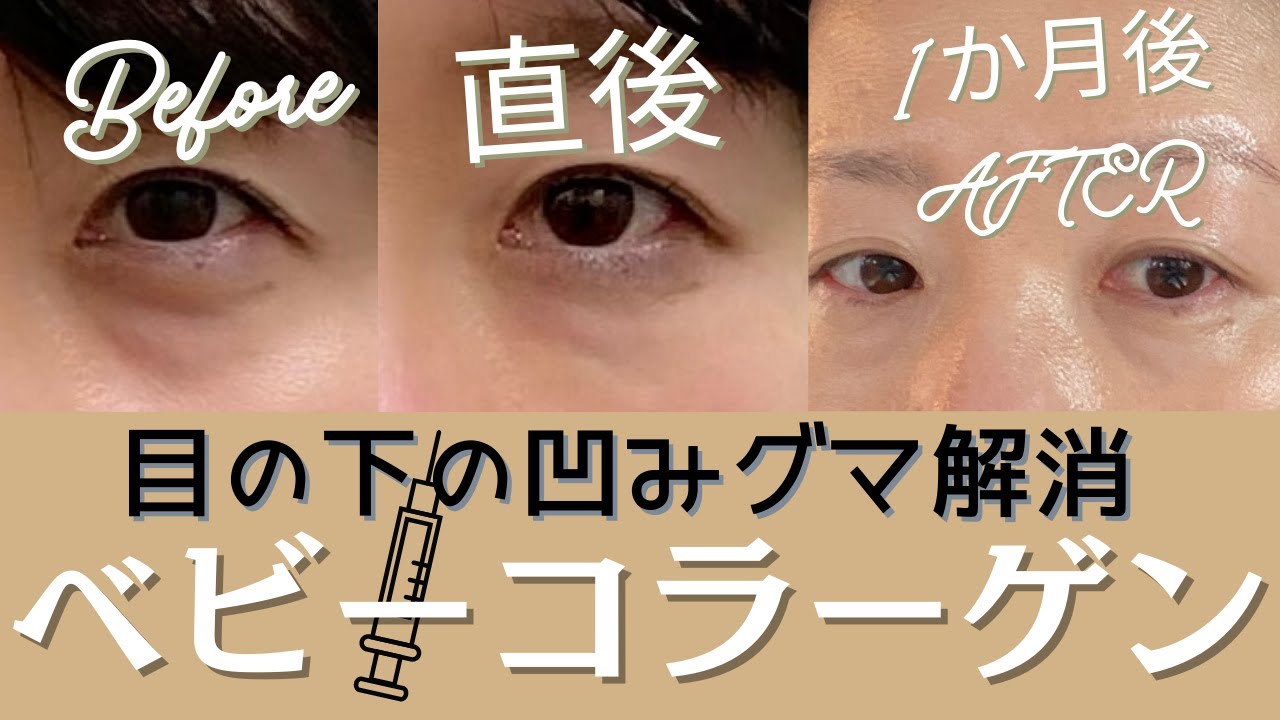 Vol.42 【美容医療／ベビーコラーゲン注入】カウンセリングから施術までガチ体験&完全レポート！