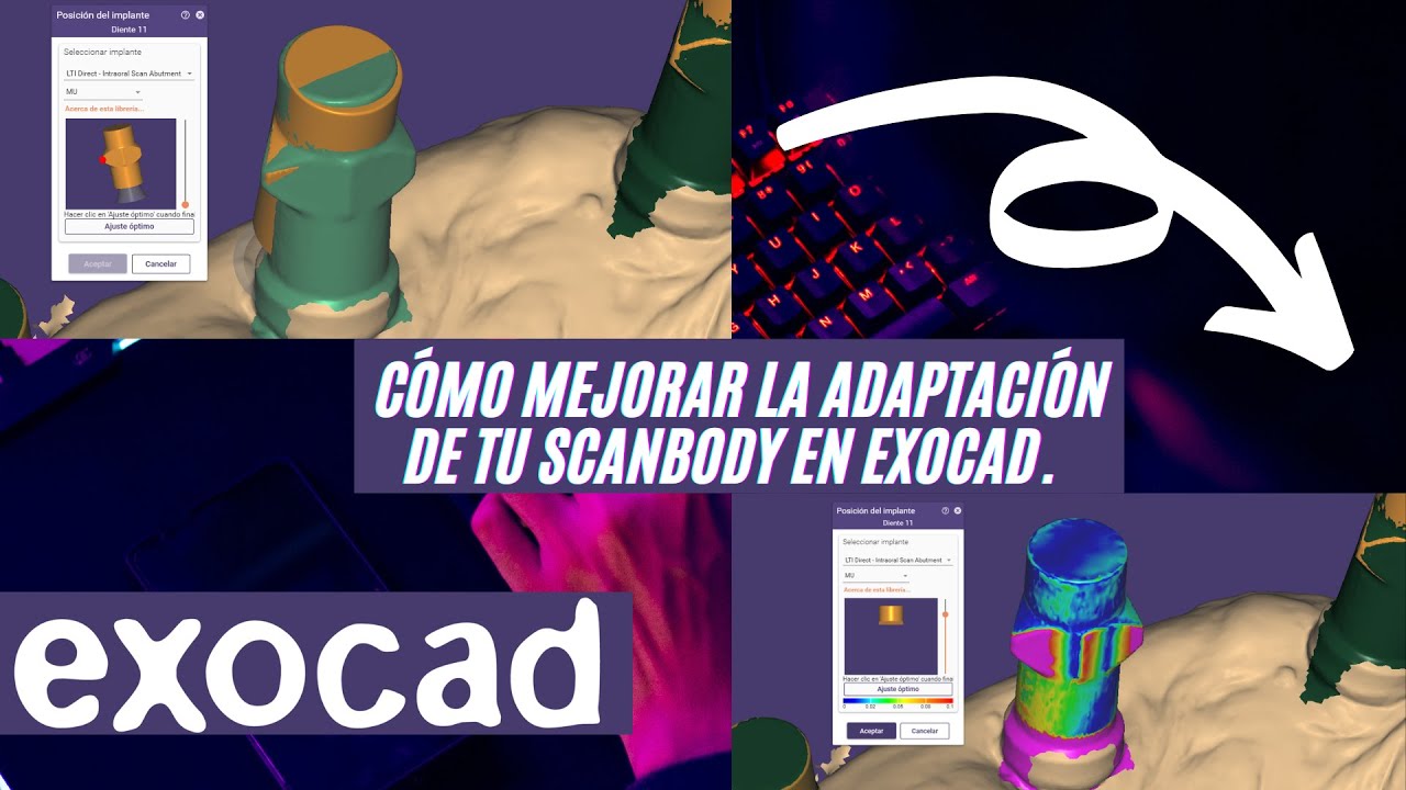 Cómo mejorar la adaptación de tu scanbody en exocad