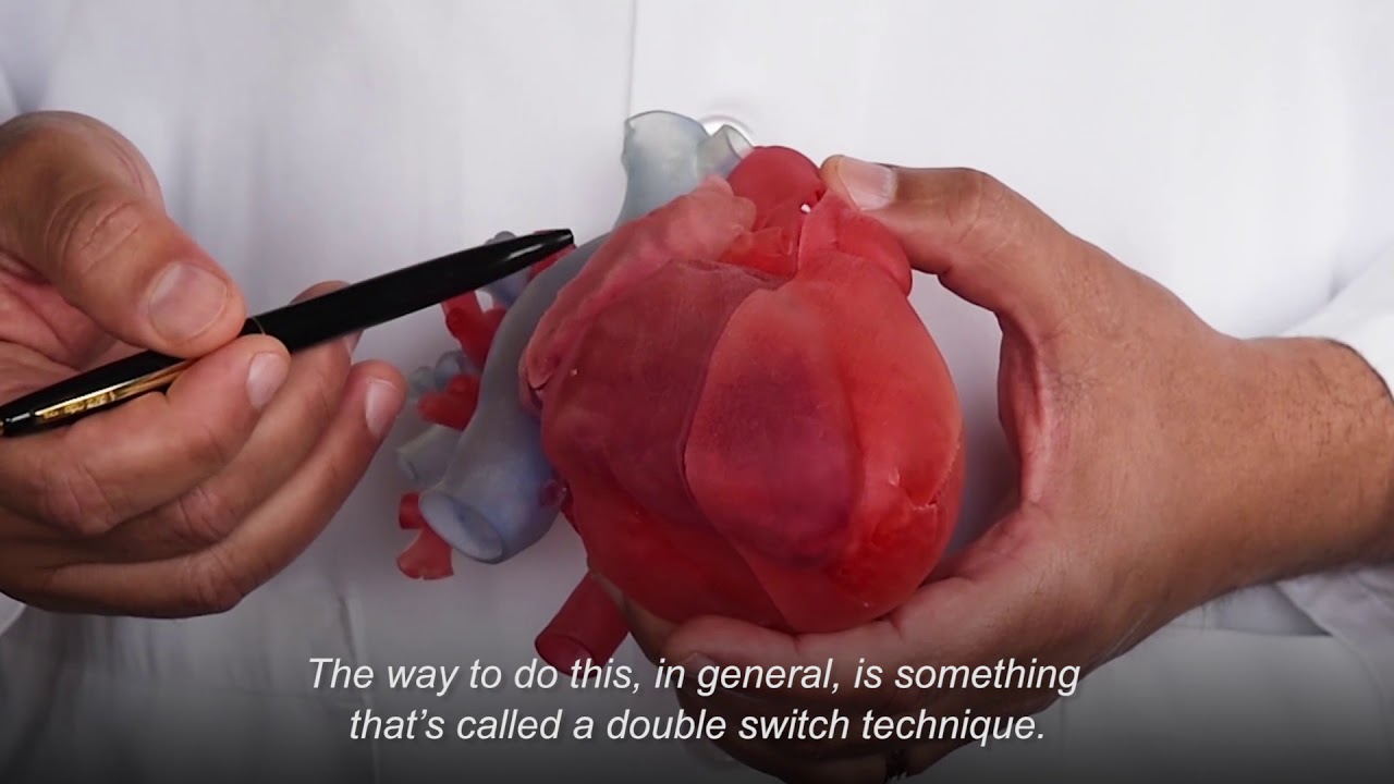 How a 3-D-Printed Heart Replica Helped Plan a Double Switch Procedure