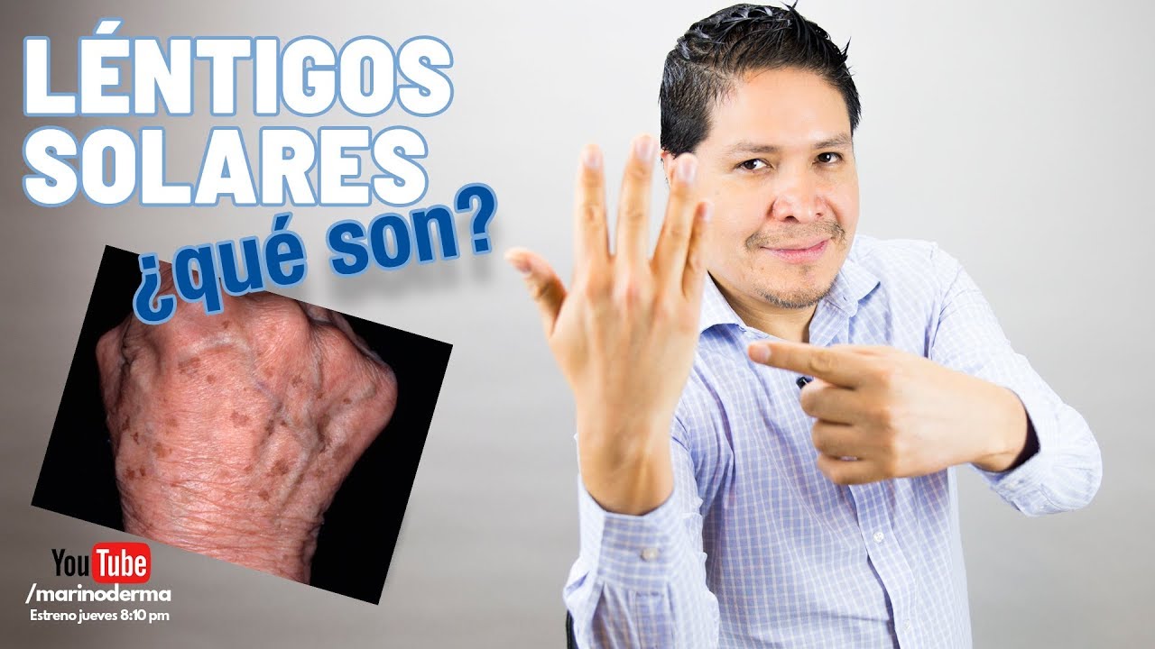 &iquest;MANCHAS EN LAS MANOS? &iquest;LENTIGOS SOLARES? II CAUSAS II TRATAMIENTOS II DR. MARINO DERMAT&Oacute;LOGO