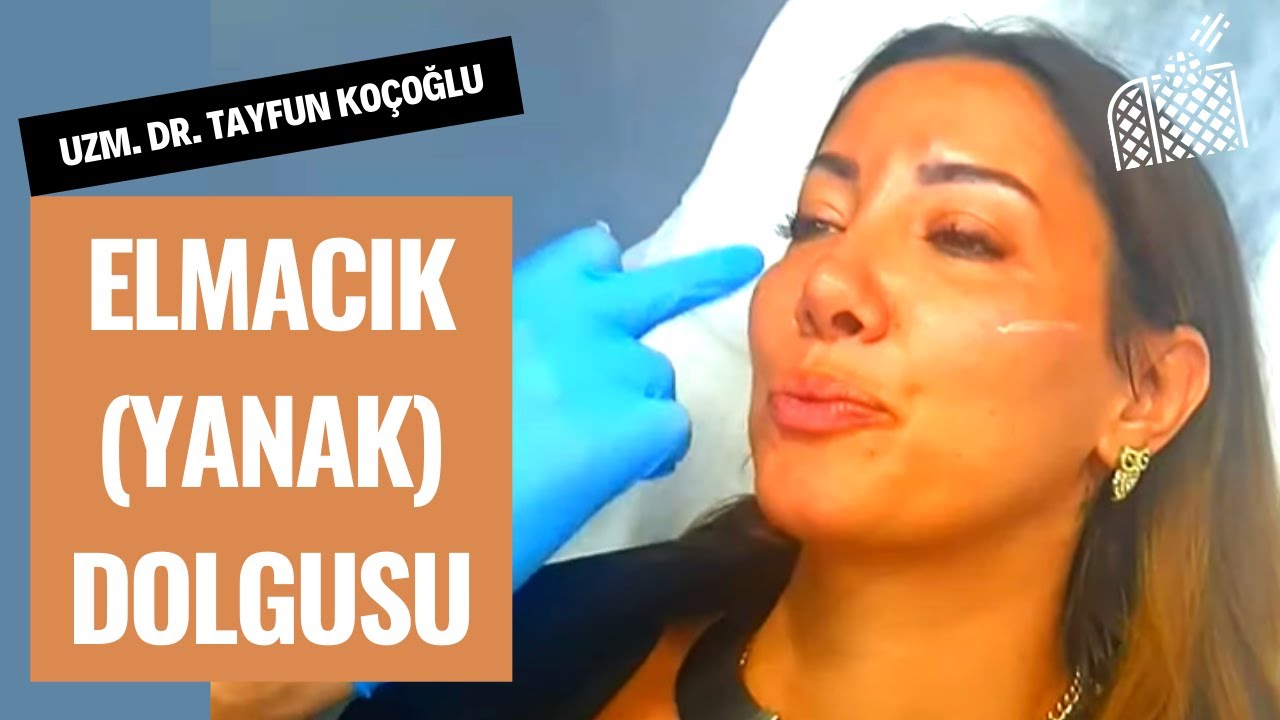Elmacık Dolgusu | Uzm. Dr. Tayfun KOÇOĞLU
