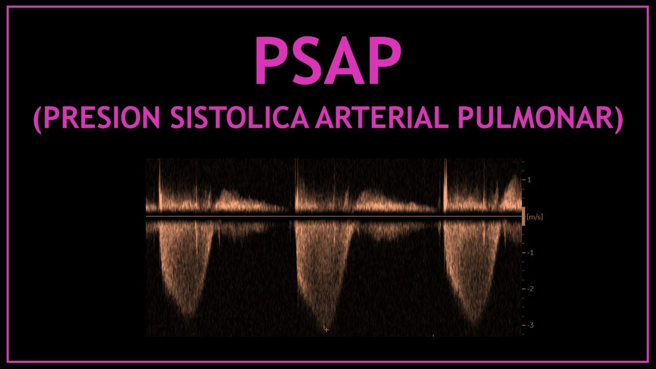 PSAP (presion sistolica de la arteria pulmonar)