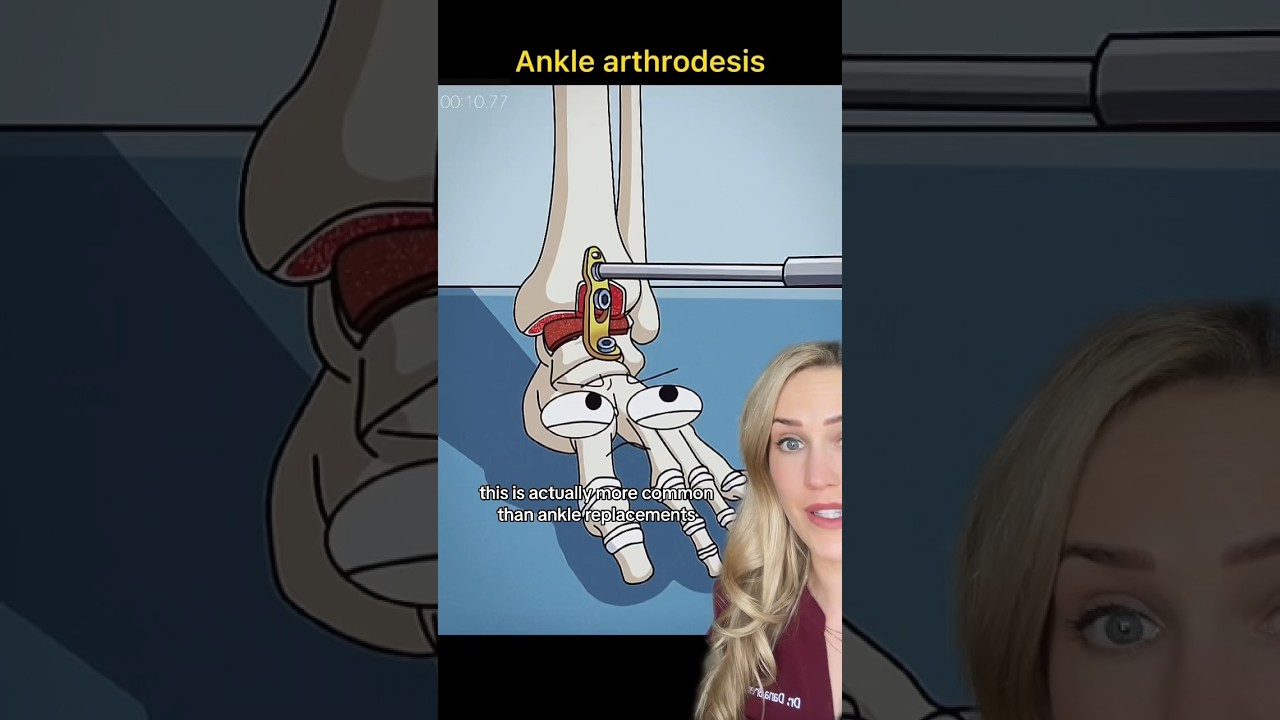 Врач объясняет: операция по артродезу голеностопного сустава