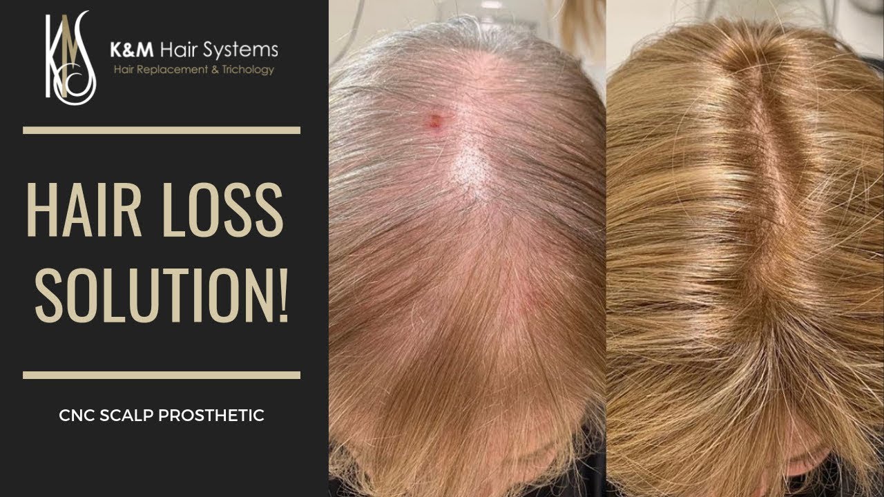 HAIR LOSS SOLUTION - CNC INSTALLATION | K&M HAIR SYSTEMS