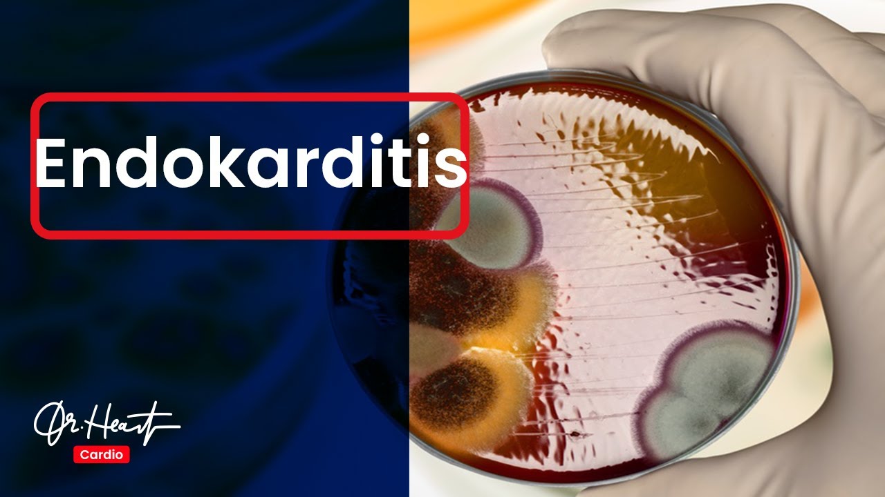 Endokarditis - unbehandelt tödlich! | Dr.Heart