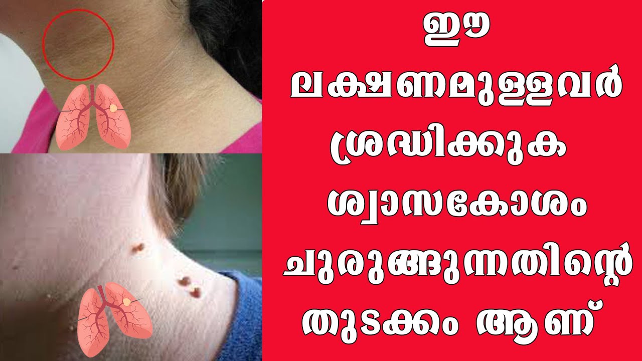 ഈ ലക്ഷണമുള്ളവർ ശ്രദ്ധിക്കുക ശ്വാസകോശം ചുരുങ്ങുന്നതിന്റെ തുടക്കം ആണ്  @BaijusVlogsOfficial