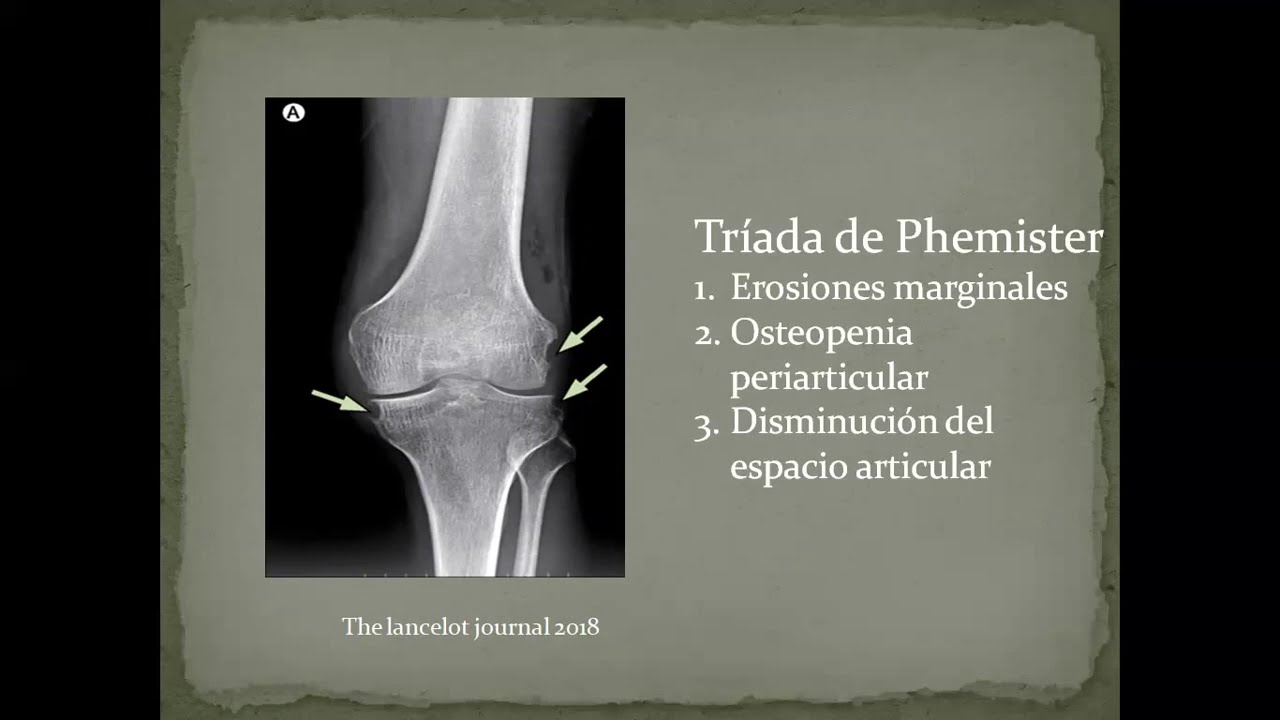 ATENEO: Tuberculosis osteoarticular