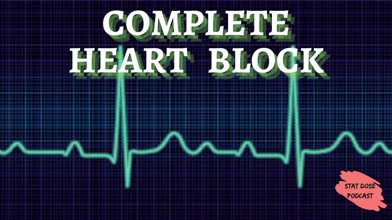 Complete heart block