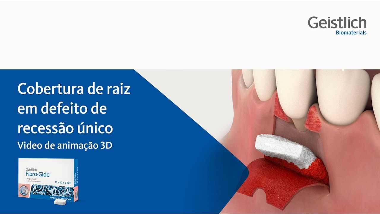 Geistlich Fibro-Gide&reg; - Recess&atilde;o &uacute;nico