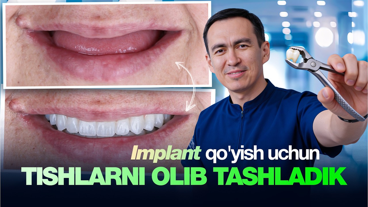 Implant qo'yish uchun hamma tishlarni olib tashlash shartmi❓
