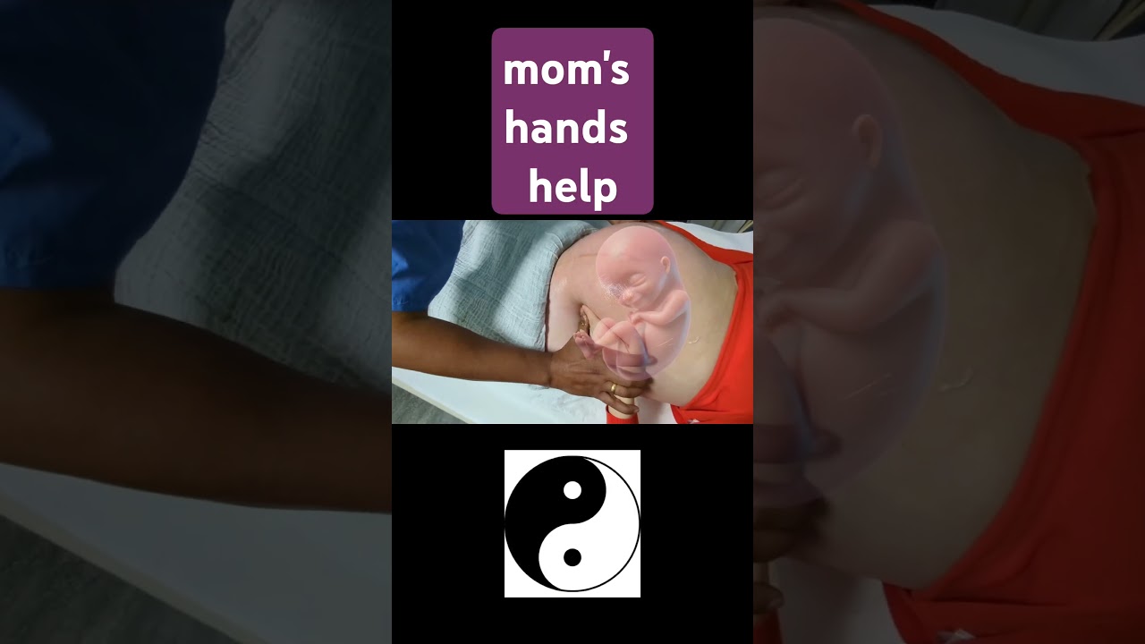 Try this new ECV for breech baby's bottom up #baby #ecv #breechpresentation #externalcephalicversion