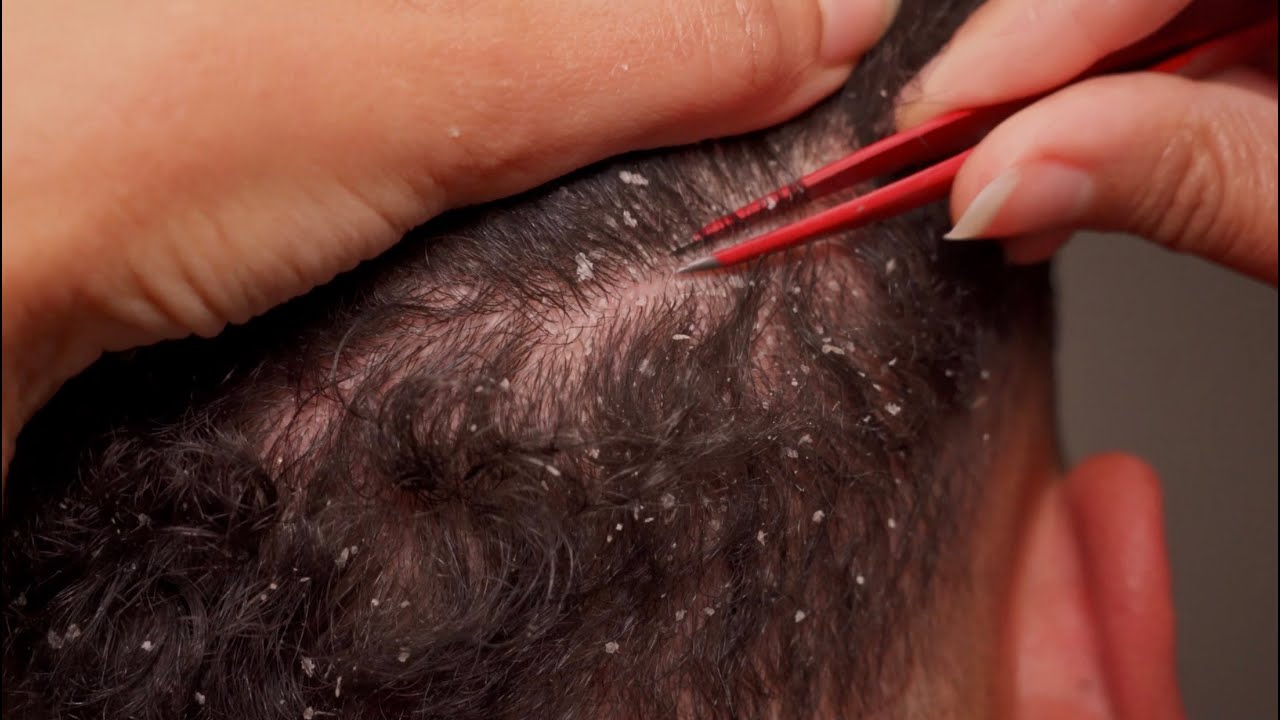 {ASMR} Most Satisfying Dandruff Removal Ever!