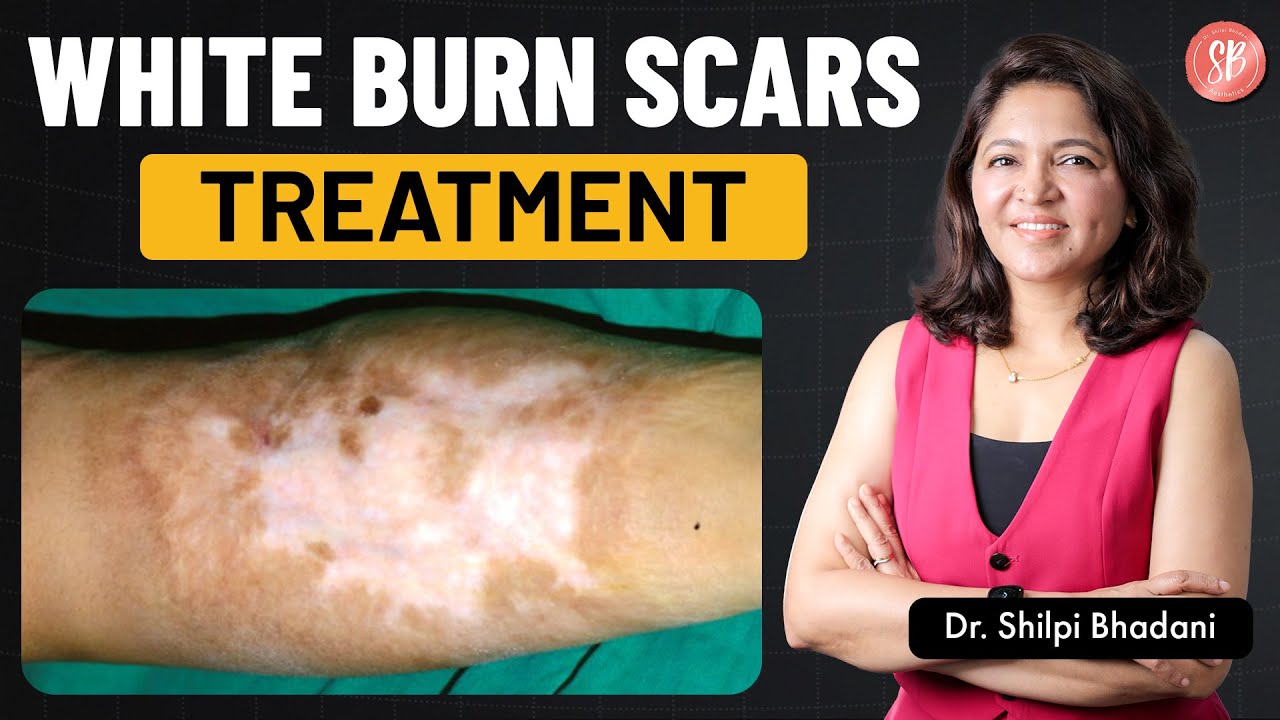 White Skin After a Burn? Causes, Pigment Loss & Best Treatments | Dr. Shilpi Bhadani | SB Aesthetics