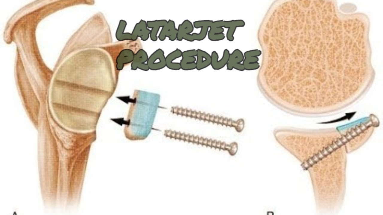 CORACOID TRANSFER - The Shoulder Surgery No One Talks About