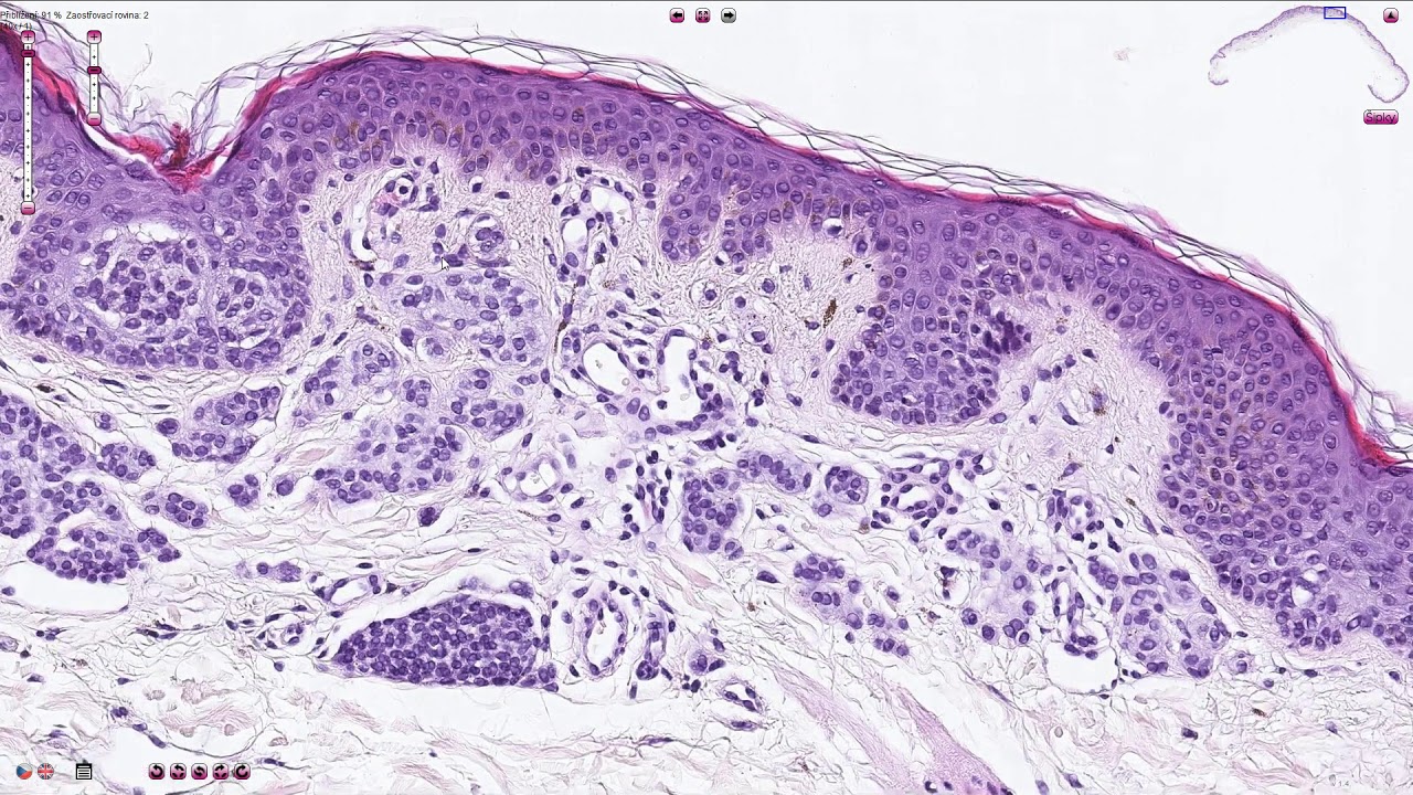 Compound Melanocytic Nevus - Histopathology
