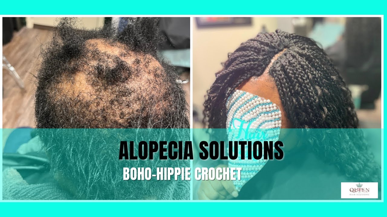 Crochet for Alopecia | Beginner-Friendly Technique (Education Preview)