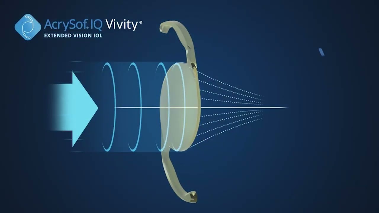 EDOF &ndash; Alcon VIVITY - Extended Vision IOL
