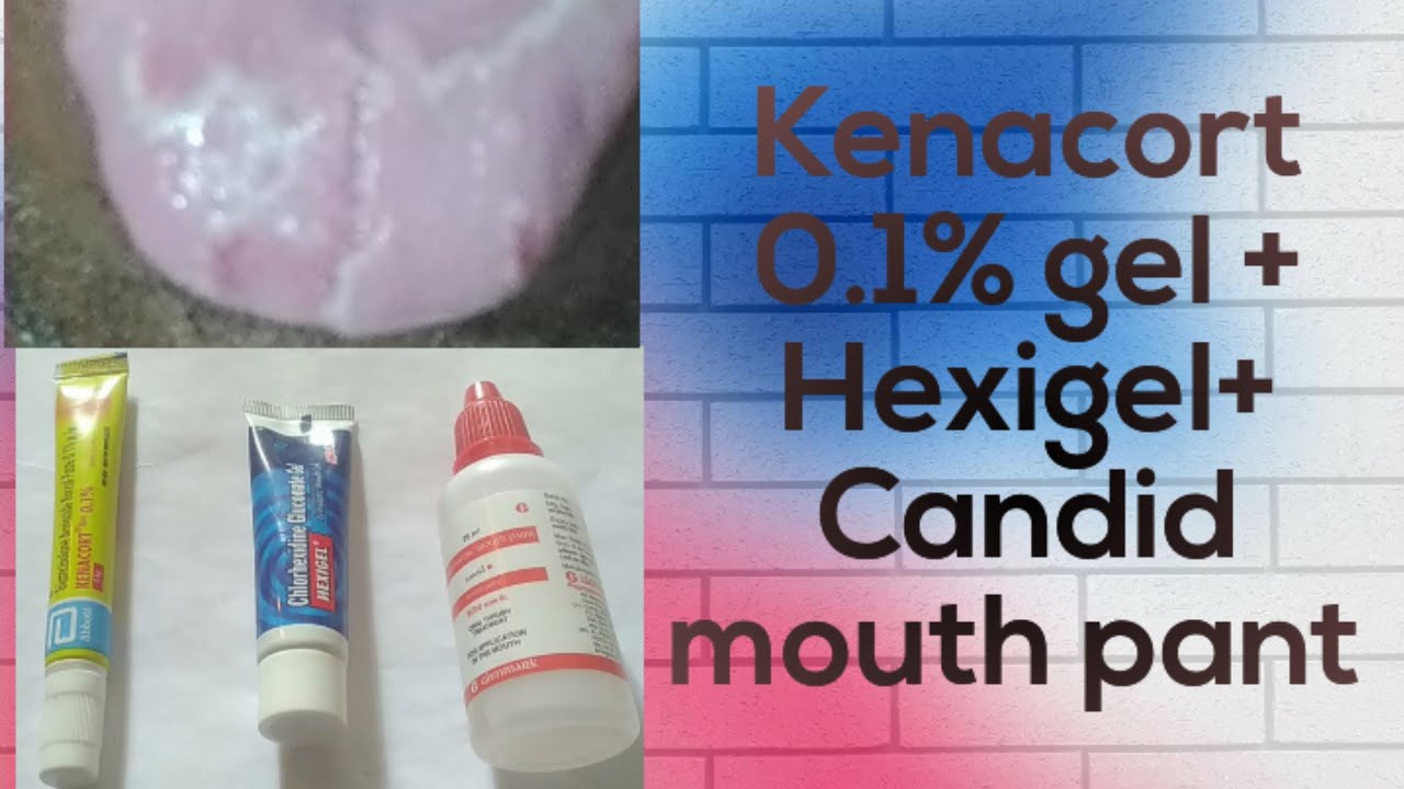 Hexigel + kenacort  0.1%  + Candid mouth pantकुछ ही दिनों मैं ठीक करें जीभ का सफेद होनाmouth fungal