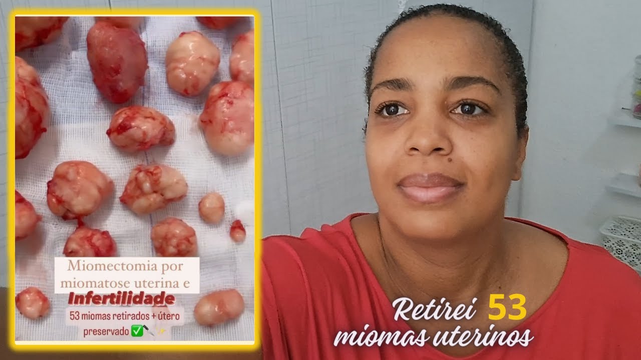 MEU TESTEMUNHO | RETIREI 53 MIOMAS | DIÁRIO DE MIOMA #18