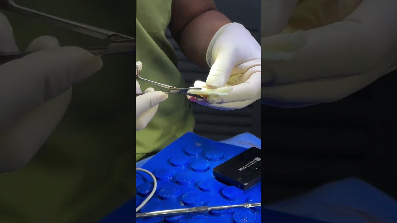 Proper Carving of the Irradiated Dermis for Nasal Bridge Augmentation #Drshimmian