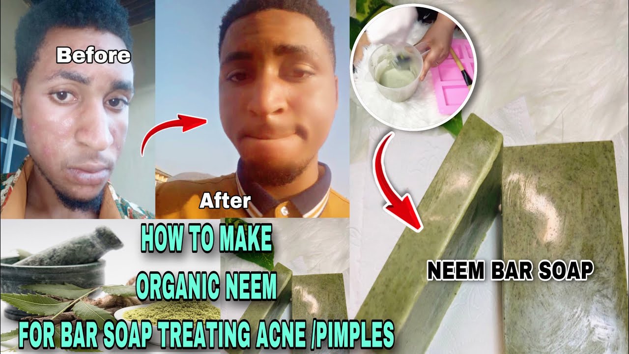 HOW TO MAKE ORGANIC NEEM BAR SOAP FOR ACNE, PIMPLES SKIN | EASY RECIPE