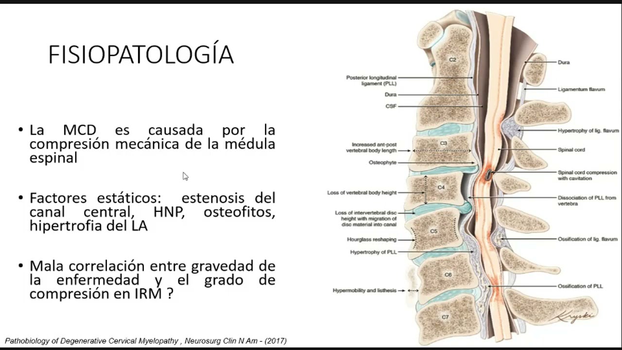 MIELOPATÍA CERVICAL ESPONDILOARTROSICA