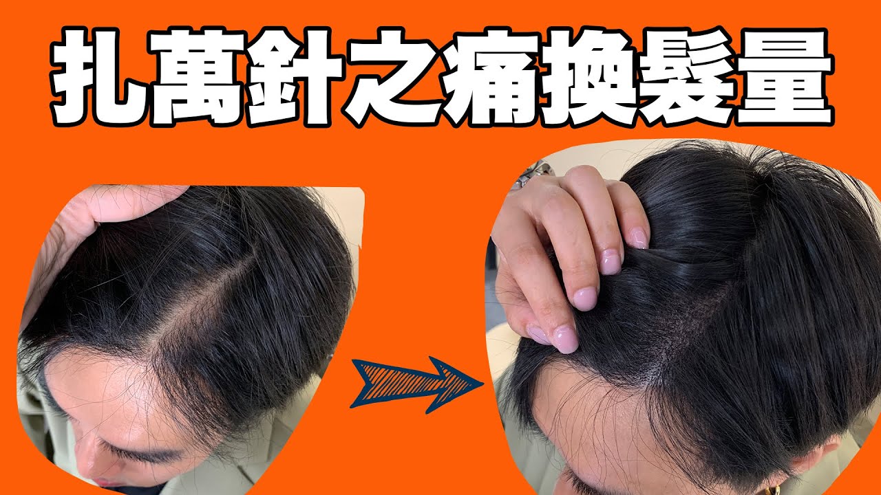 植髮真的有用嗎？九個月術後心得大公開 Ft.愛美教主