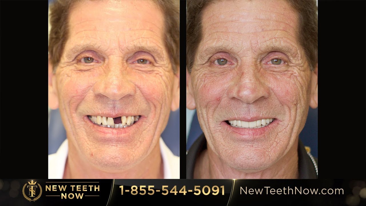 New Teeth Now  - Tim wanted teeth back in his mouth.