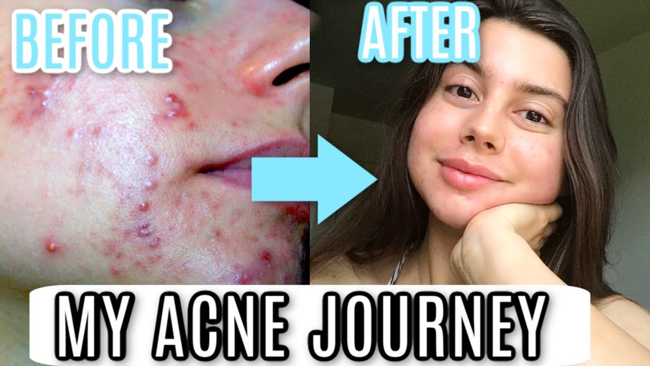 MY ACNE JOURNEY STORY || HOW I CLEARED MY SKIN, EVERYTHING YOU NEED TO KNOW.