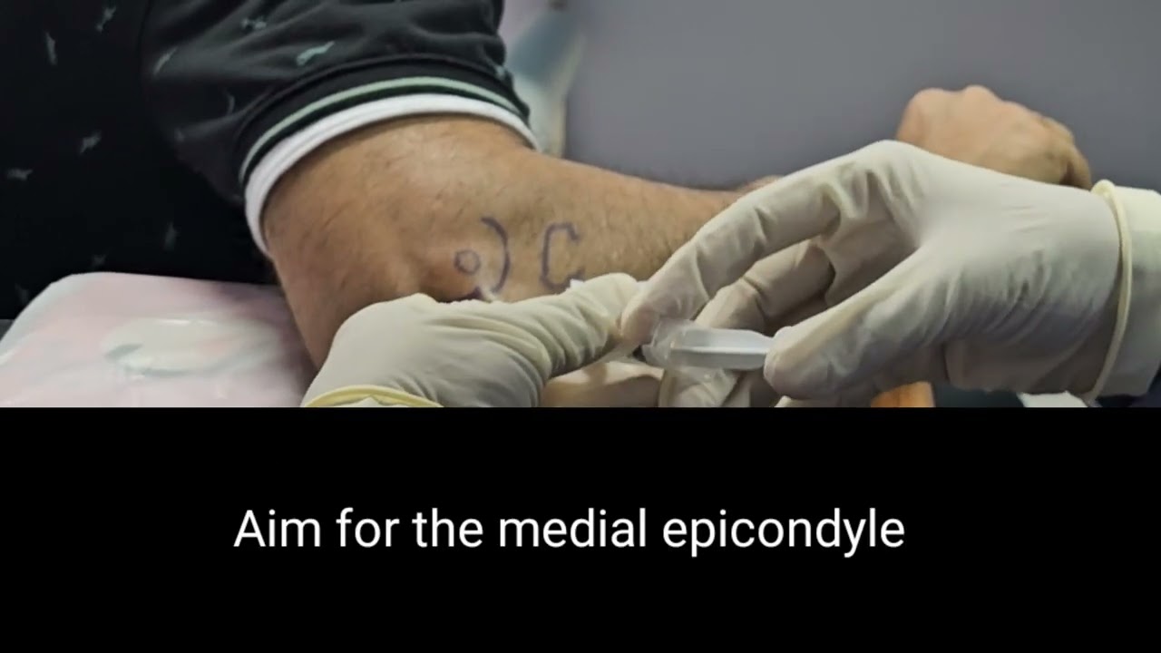 Elbow Joint (Ulnohumeral Joint) Steroid Injection| Dr Pradeep Bala