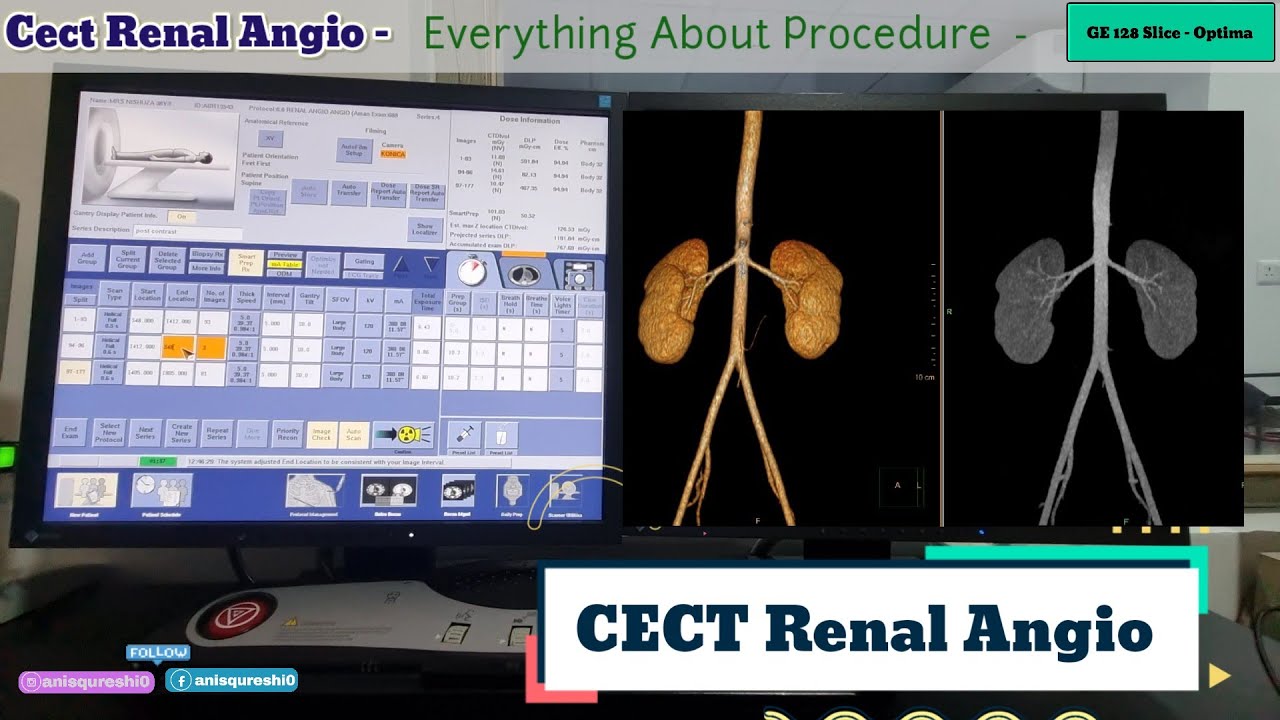 CT Renal Angiography Explained | Positioning, FOV, ROI, Phases & HU Values | Complete Guide 