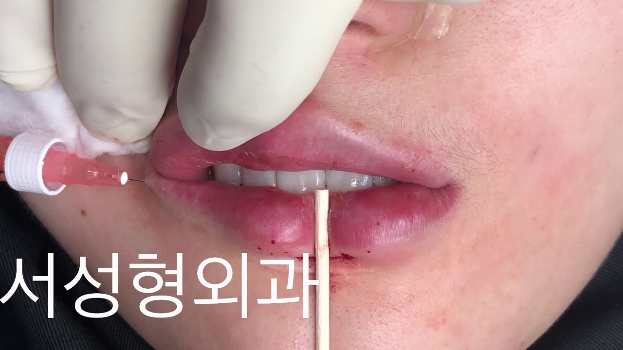 입꼬리가 올라가 보이는 입술필러 와이솔루션540 학회발표용 김종서성형외과 성형외과학술위원