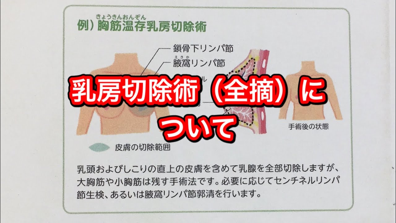 乳房切除術（全摘）について